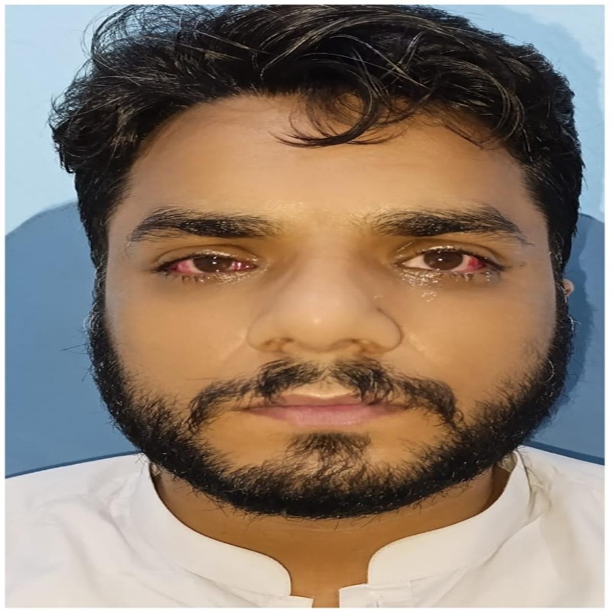 After Squint Surgery - Eyes aligned