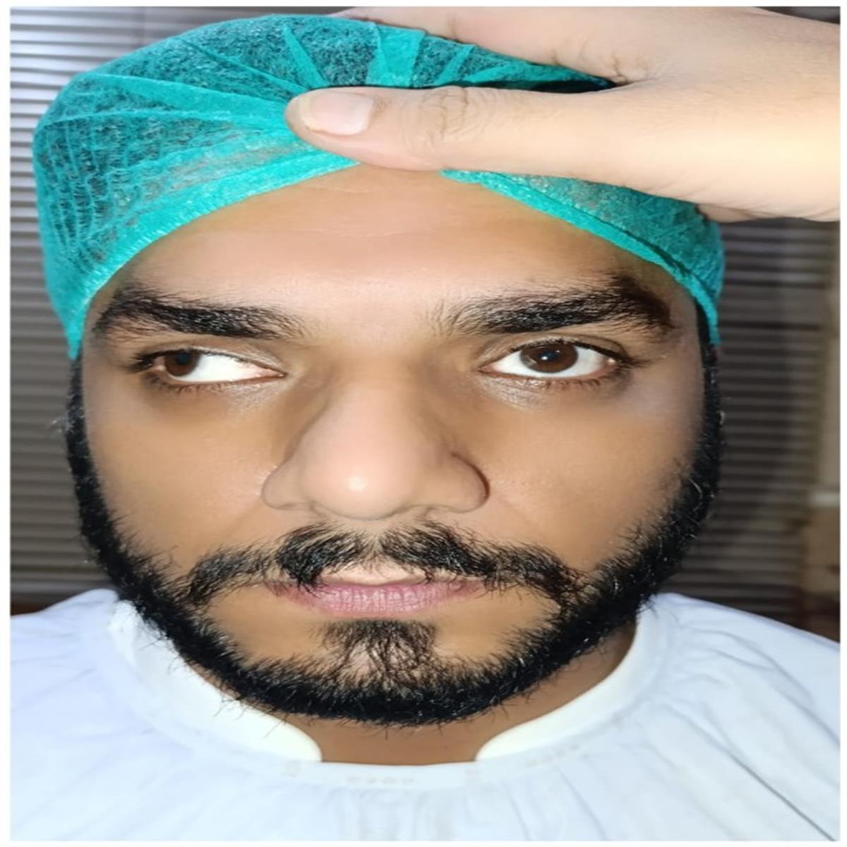 Before Squint Surgery - Eye misalignment