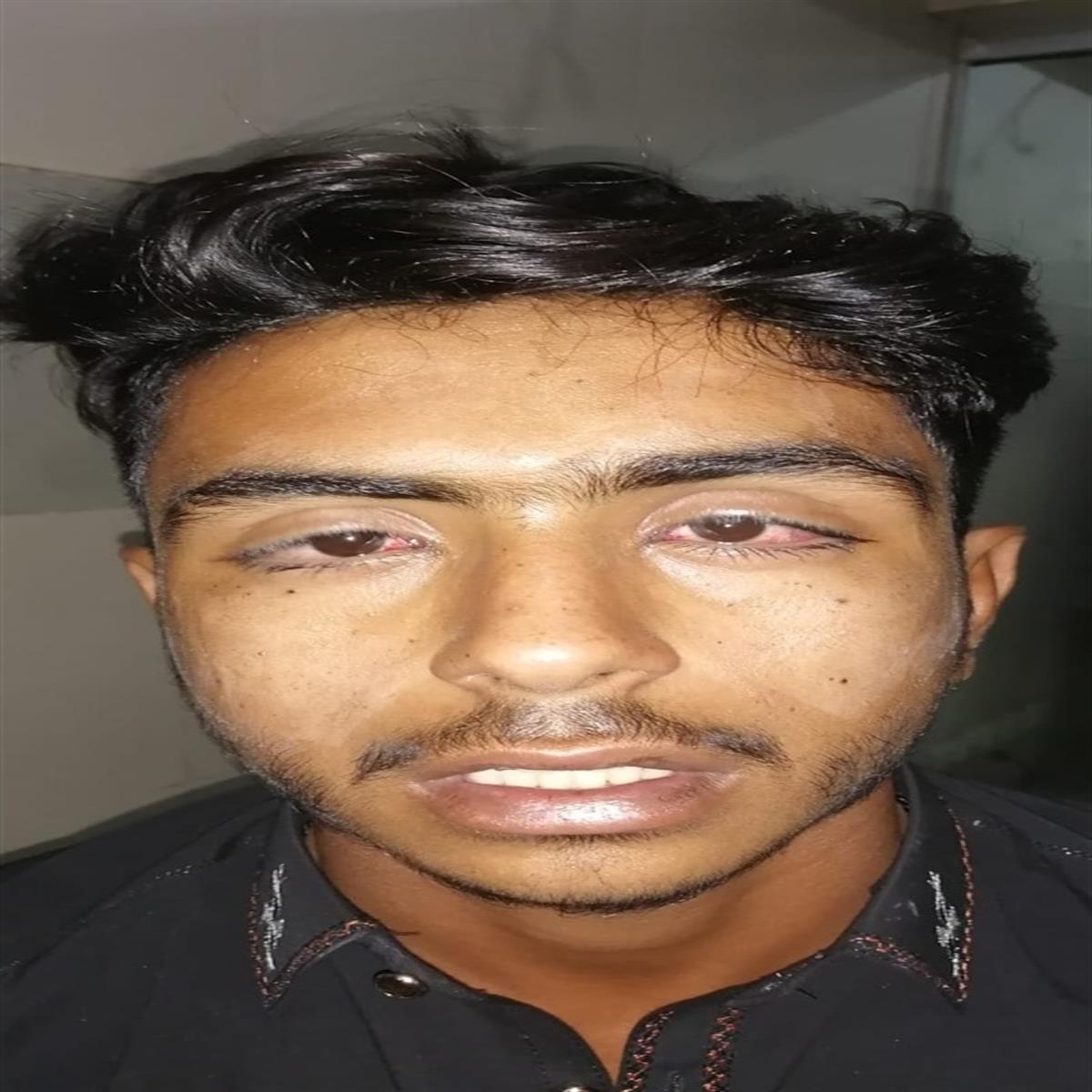 After Ptosis Surgery - Restored eyelid
