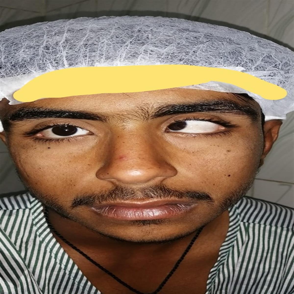 Before Ptosis Surgery - Eyelid drooping