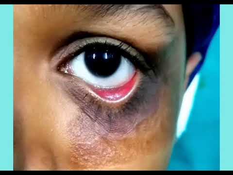 Clinical Examination & Eyelid Assessment - Dr. Kashif Jahangir