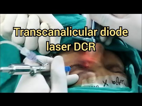 Transcanalicular Diode Laser DCR Surgery - Dr. Kashif Jahangir
